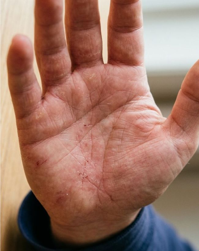 Itchy Palm liver disease-1-2