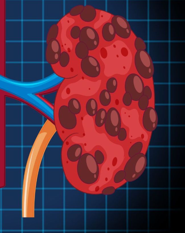 Silent signs of Kidney disease-1-2-3-4-5-6-7