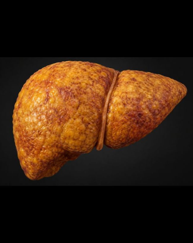 Fatty Liver Signs in Feet-1-2-3-4