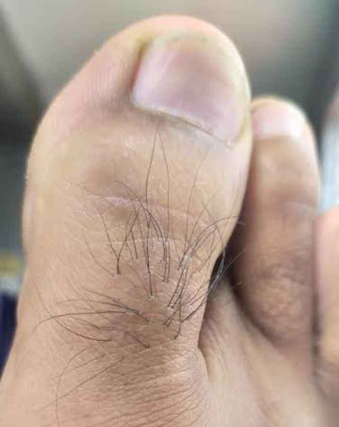 पेरिफेरल एलोपेशिया 