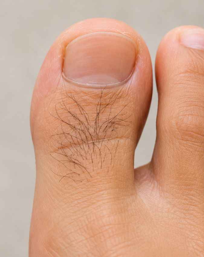 नाइट्रिक एसिड और एंथोलियम कैसे होते हैं कम 