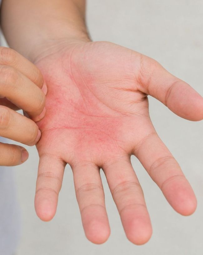 Itchy Palm liver disease-1-2-3