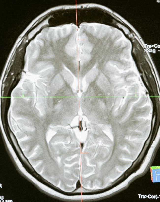 Brain Aging Signs-1-2-3-4-5-6-7