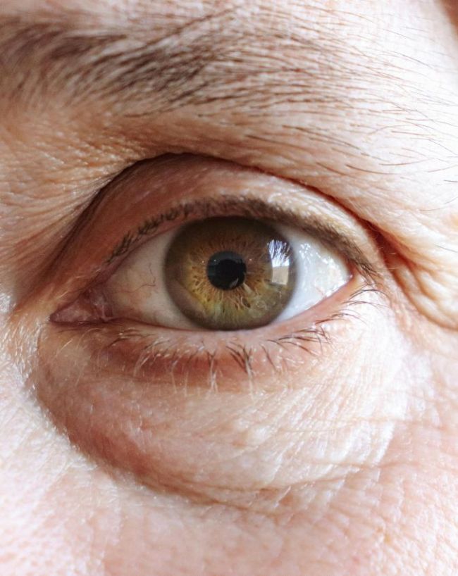Silent signs of Kidney disease-1-2-3