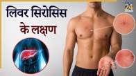 Liver cirrhosis symptoms