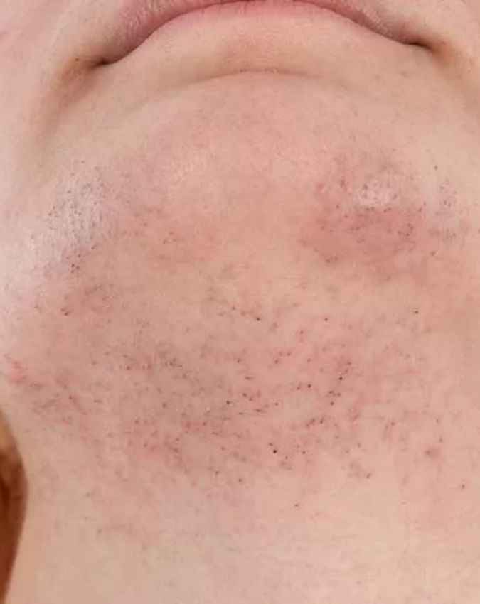 उम्र बढ़ने पर क्यों आने लगते हैं चेहरे पर बाल?