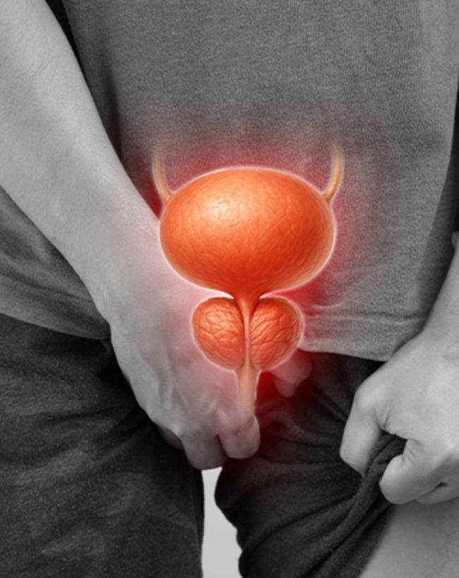 prostate cancer in men-1-2