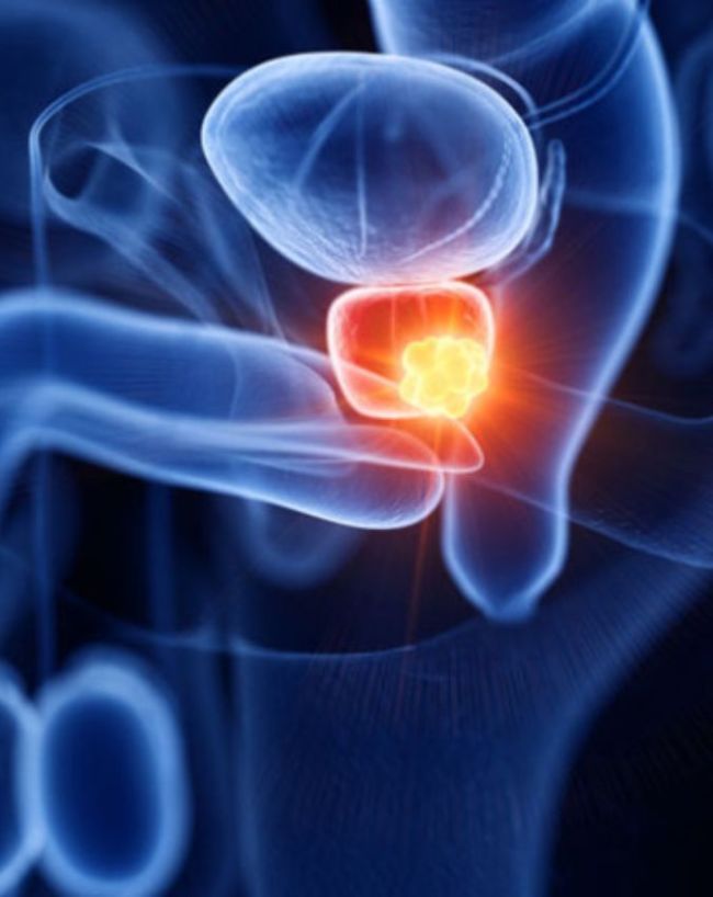 prostate cancer in men-1-2-3-4