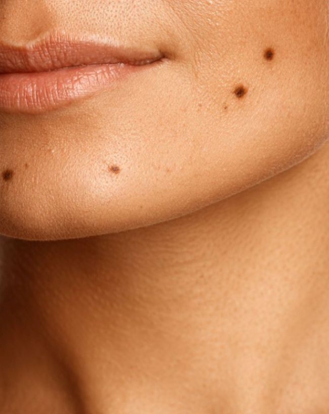 Throat Mole Infection-1-2-3