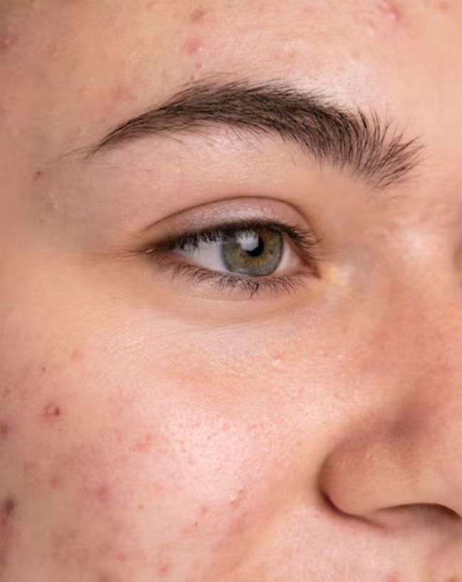 Pimples Causes-1-2-3-4-5-6