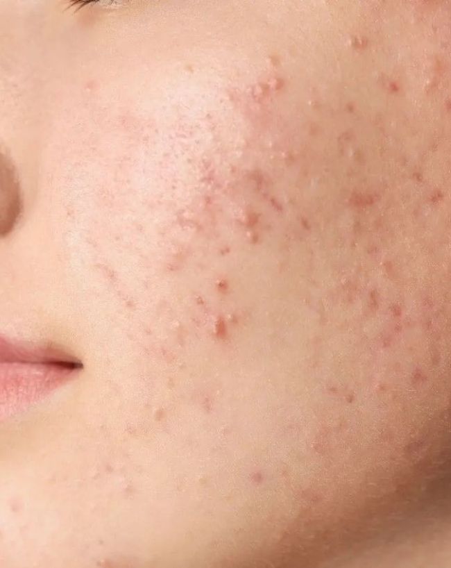 Pimples Causes-1-2-3-4-5