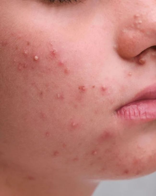 Pimples Causes-1-2-3-4