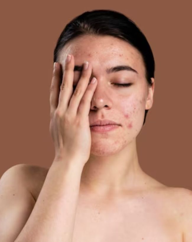 Pimples Causes-1-2-3