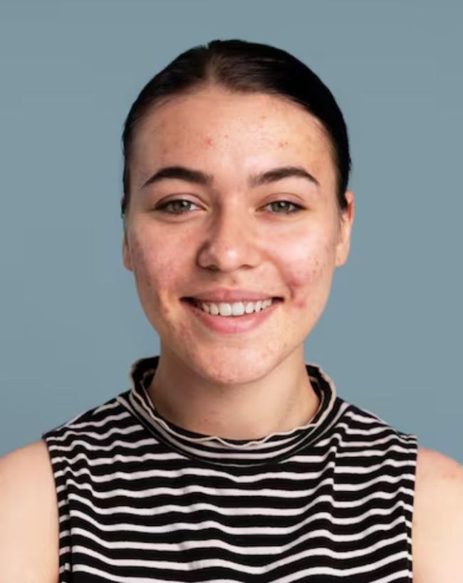 Pimples Causes-1-2