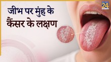 Mouth Cancer Oral Cancer Symptoms