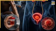 Bladder Cancer Causes