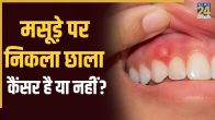 Mouth Cancer Symptoms