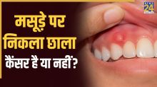 Mouth Cancer Symptoms