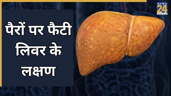 Fatty Liver Signs in Feet Fatty Liver Signs in Feet-1