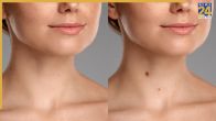 Throat Mole Infection