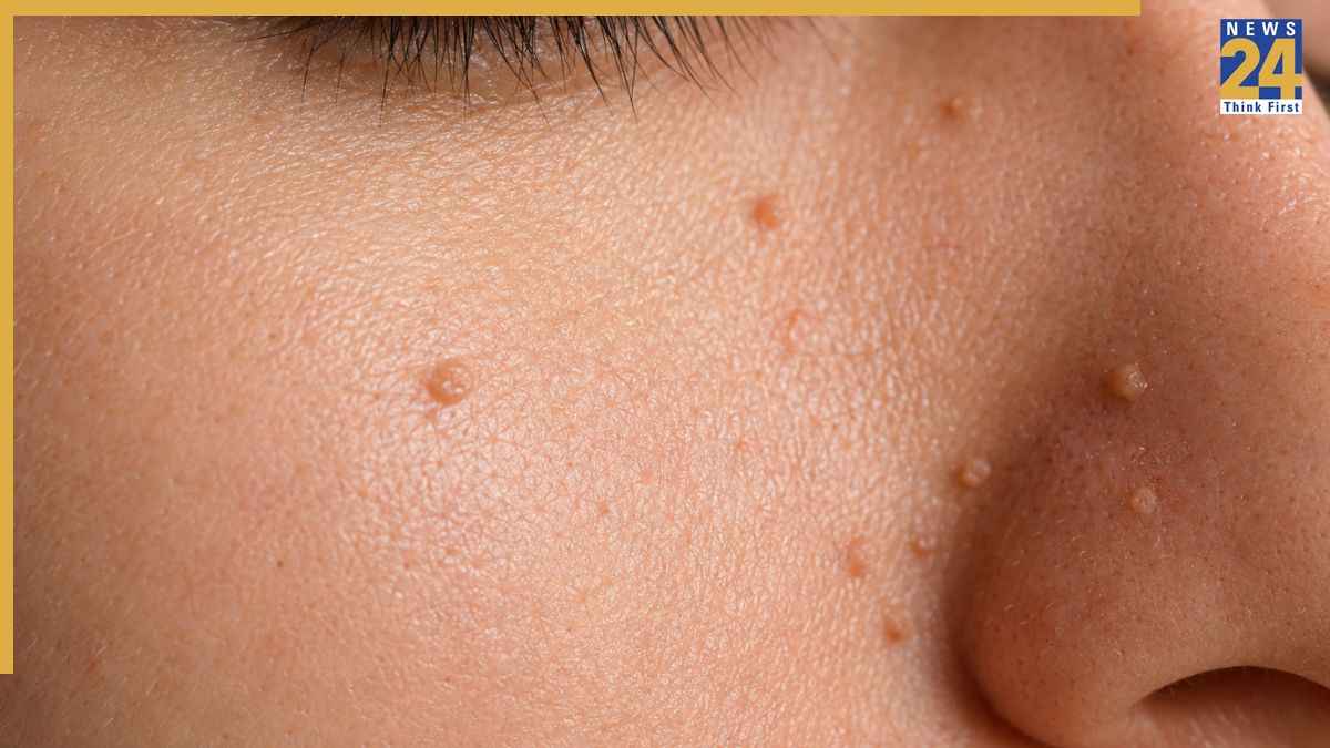 मस्सों को जड़ से खत्म कैसे करें? डॉक्टर ने बताया 100 साल पुराना आयुर्वेदिक नुस्खा