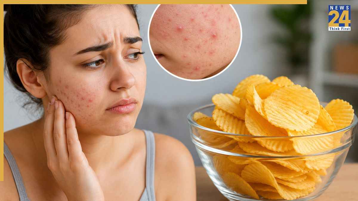 क्या चिप्स खाने से दाने होते हैं? डाइटिशियन ने बताए चिप्स खाने के साइड इफेक्ट्स