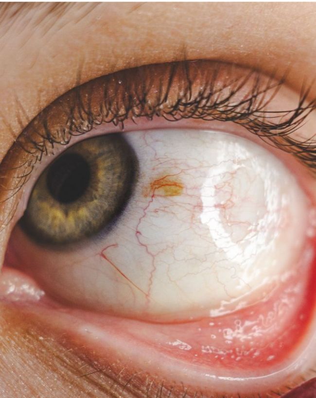 Monsoon Eye Infection-1-2-3-4-5