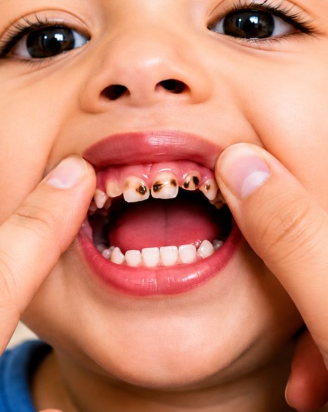 Milk Tooth Cavity Causes-1-2-3-4-5