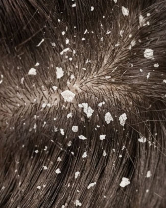 Dandruff kis chij ki kami se hota hai-1-2-3-4