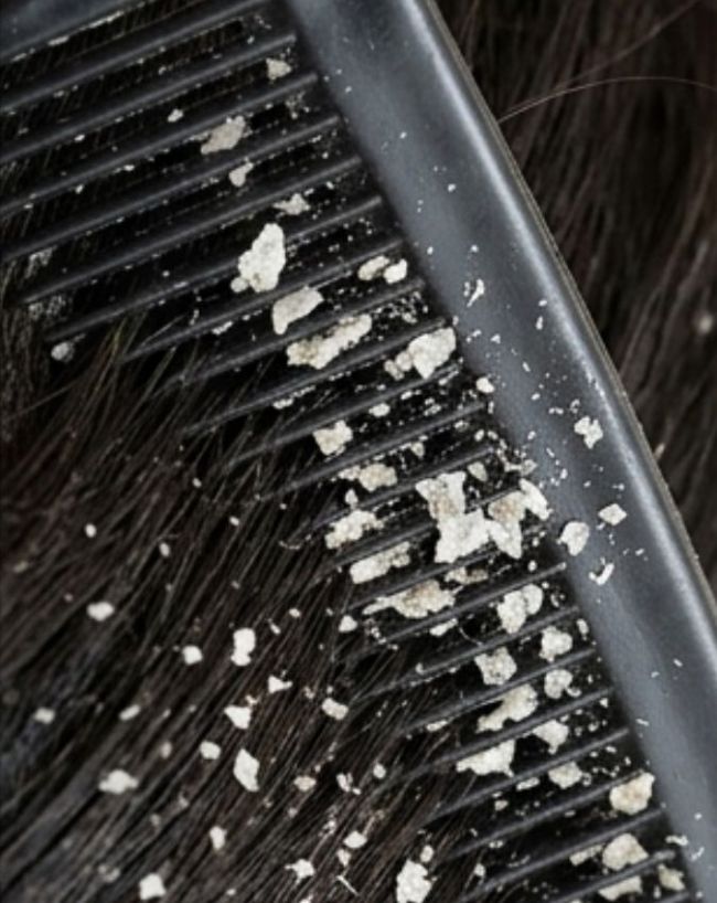 Dandruff kis chij ki kami se hota hai-1-2-3-4-5