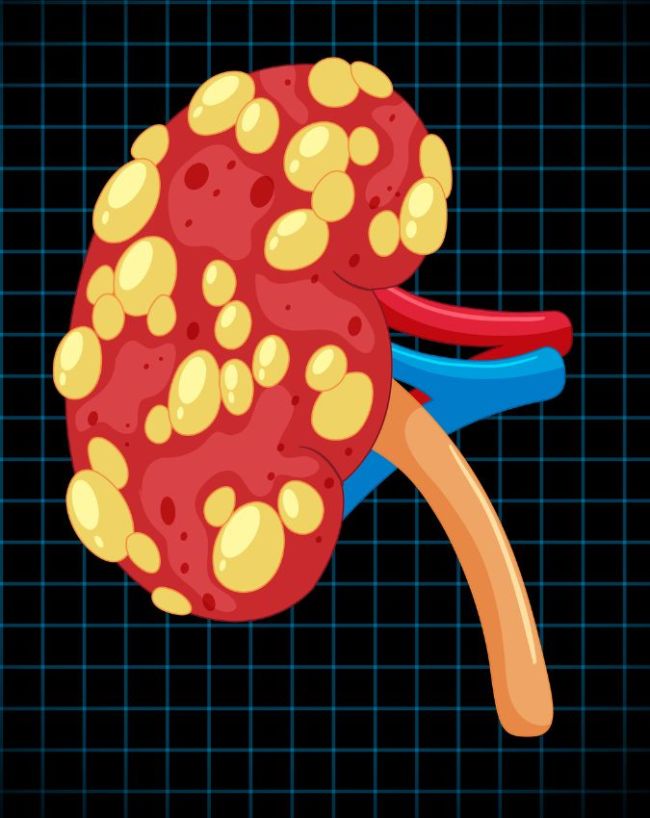 Kidney Disease Early Detection-1-2-3-4-5-6-7