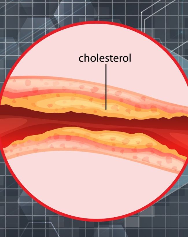 bad cholesterol-1-2-3-4-5-6-7
