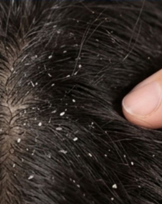 Dandruff kis chij ki kami se hota hai-1-2-3-4-5-6-7