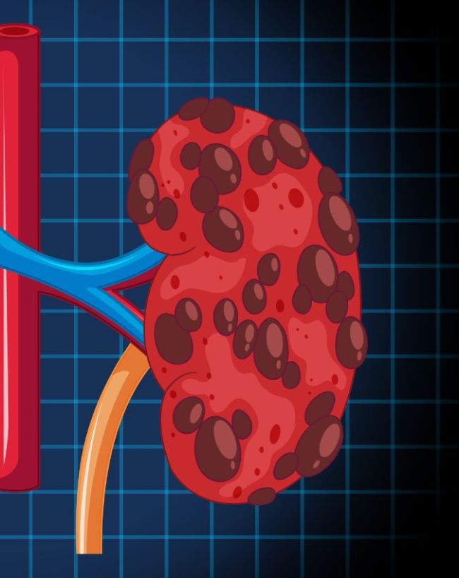 Kidney Disease Early Detection-1-2-3-4-5