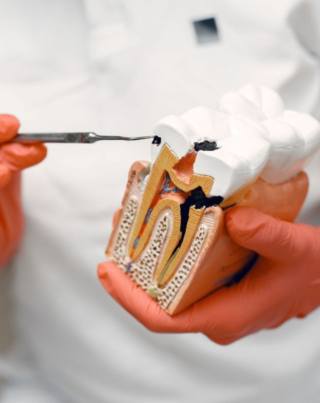Milk Tooth Cavity Causes-1-2-3-4