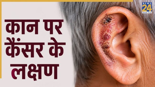 Ear Cancer Symptoms