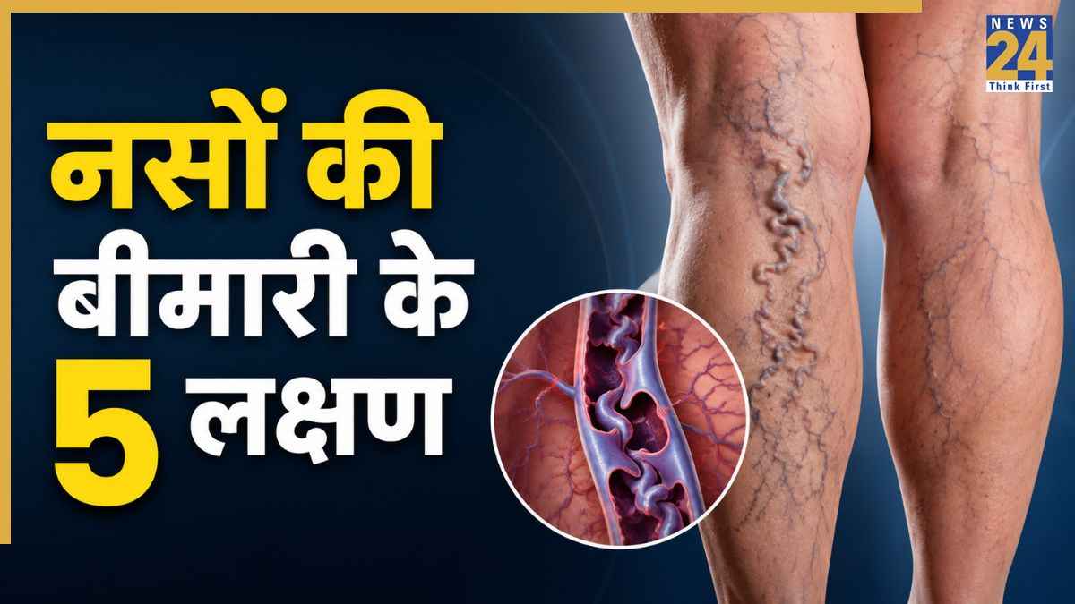 नसों की बीमारी के लक्षण कैसे दिखते हैं? वैस्कुलर सर्जन ने कहा पैरों पर दिखते हैं Vein Disease के साइन
