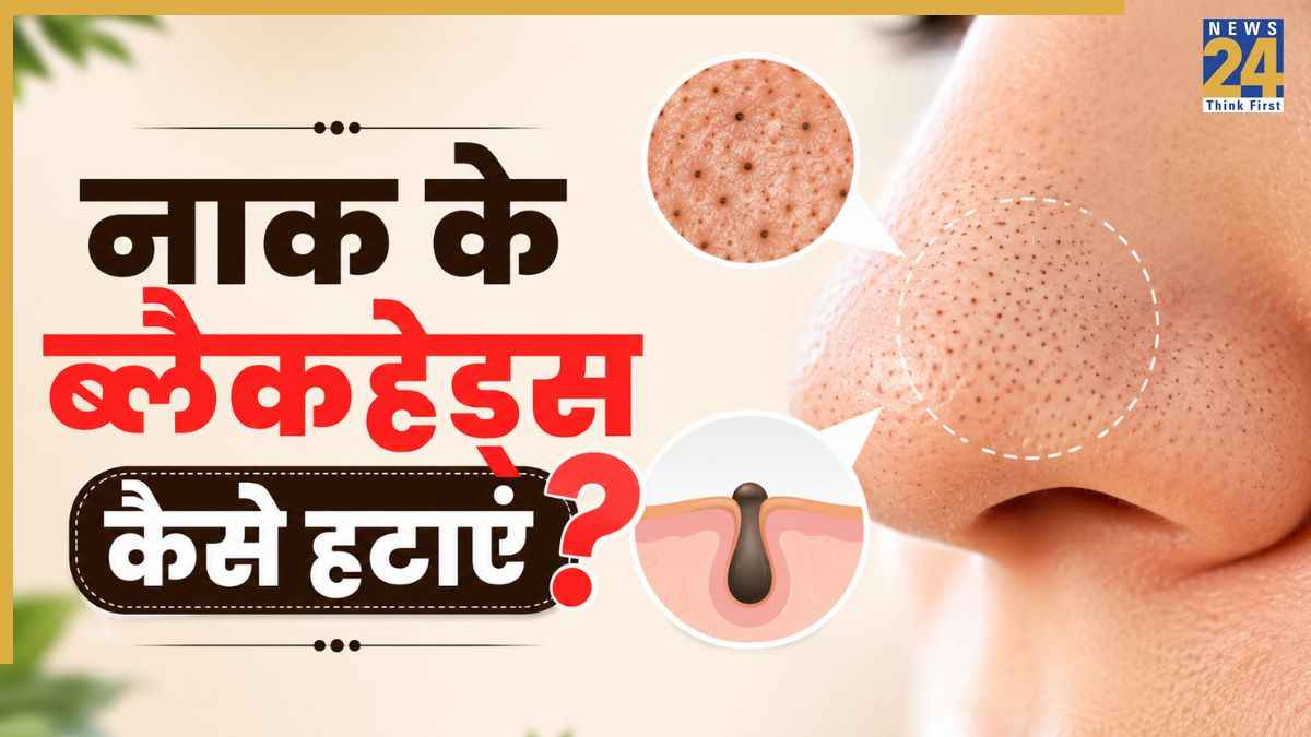 How To Remove Blackheads