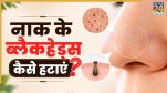 How To Remove Blackheads