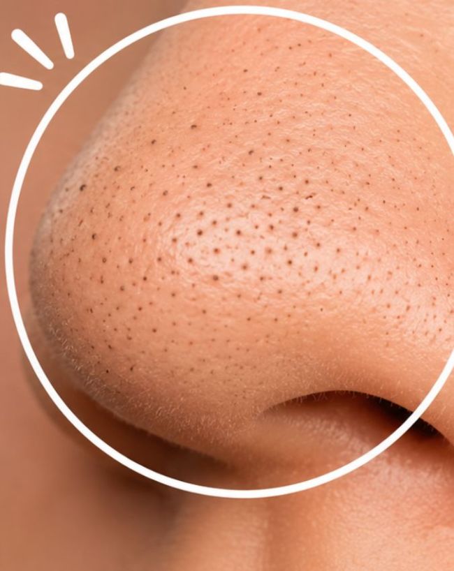 How To Remove Blackheads-1-2-3-4-5-6