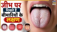 Tongue cancer treatment
