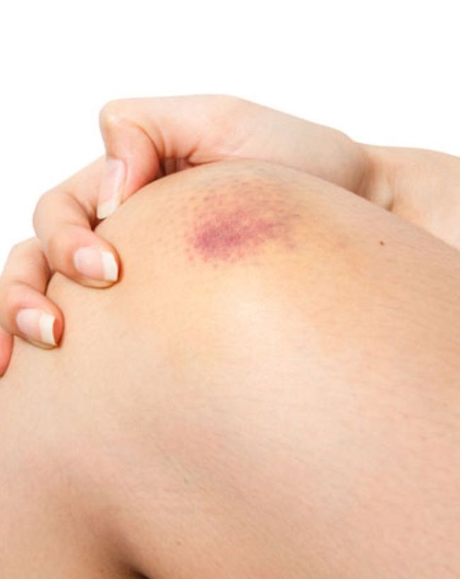 Blue Spots On Body-1-2