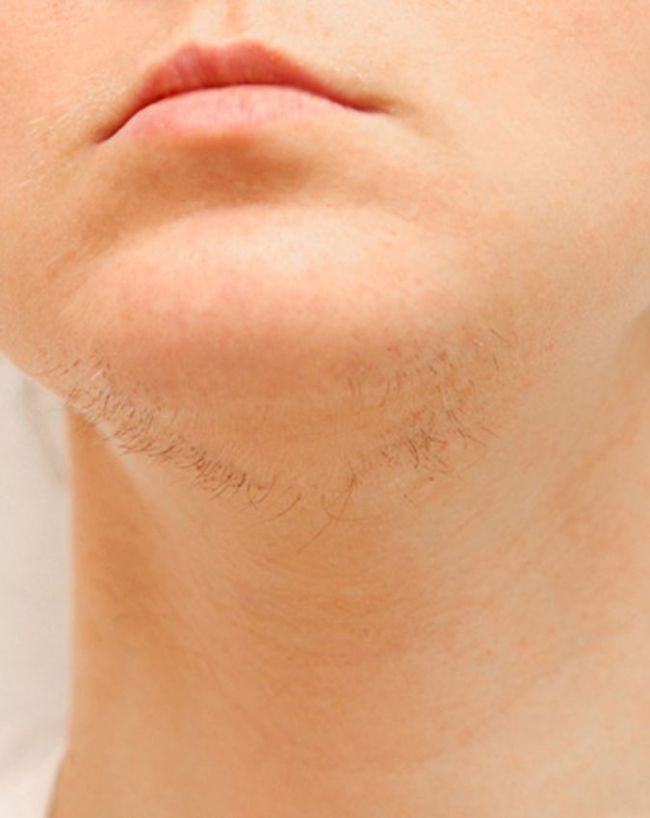 Face Hair Problem-1-2