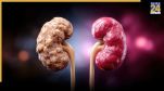 symptoms of kidney failure in 5 stages