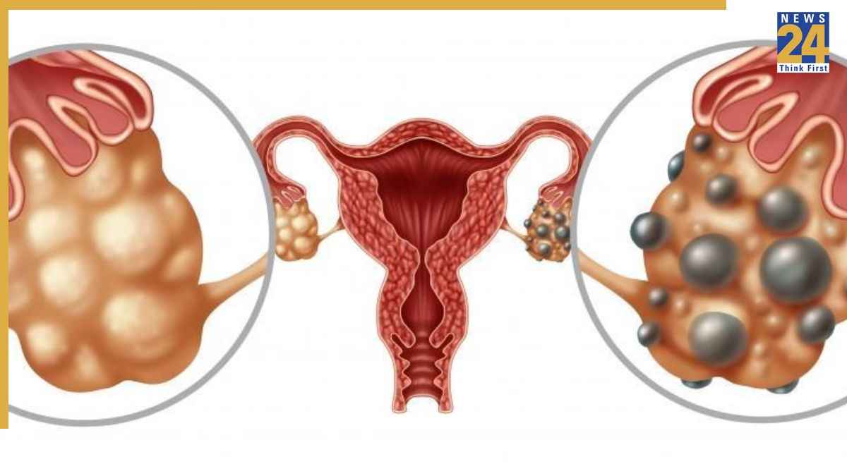 Pcos Mein Kya Dikkat Hoti Hai