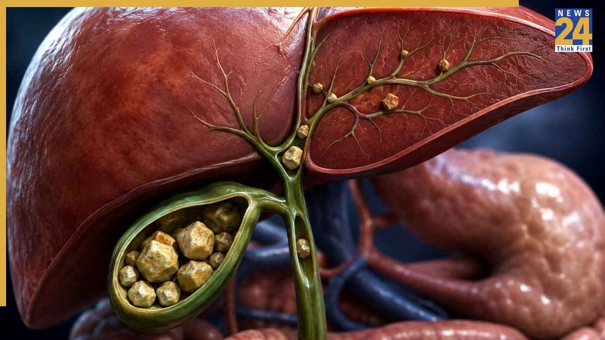क्या लिवर में पथरी होती है? स्टेज 1 में दिखने वाले शुरुआती संकेत जानिए