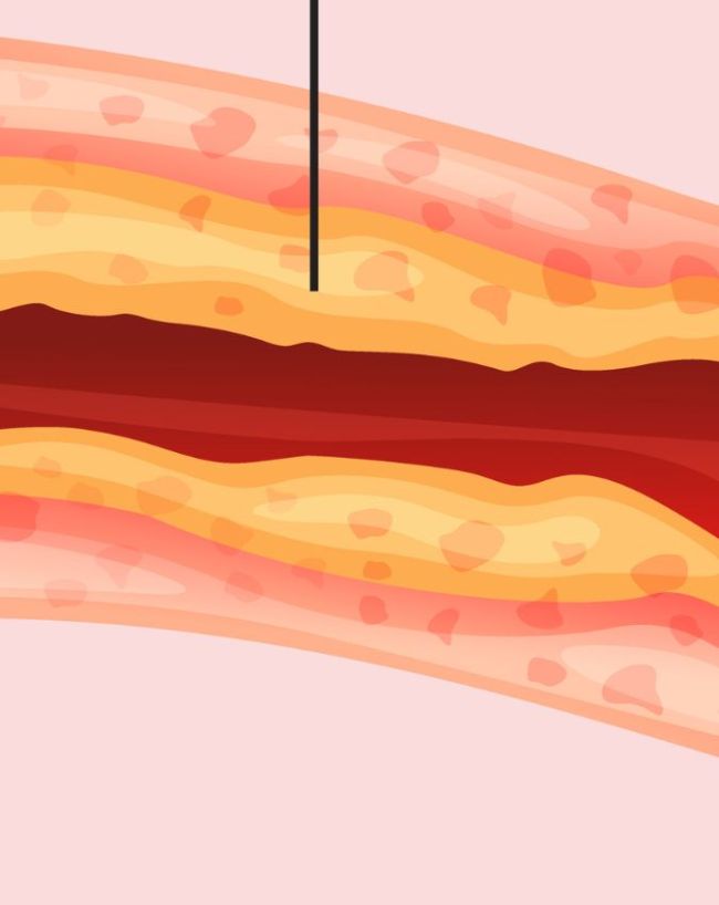 Gande Cholesterol Ke Lakshan-1-2-3-4-5-6-7
