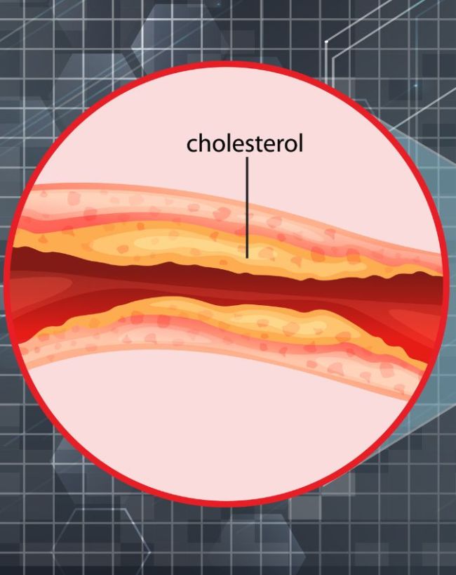 Bad Cholesterol Signs On Body-1-2