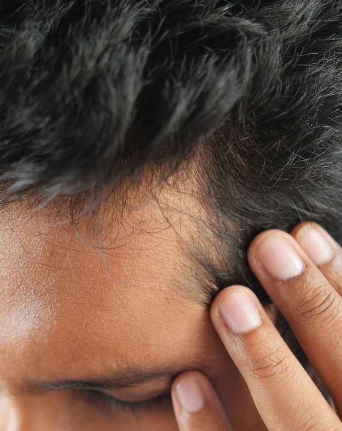 ऑयली स्कैल्प 