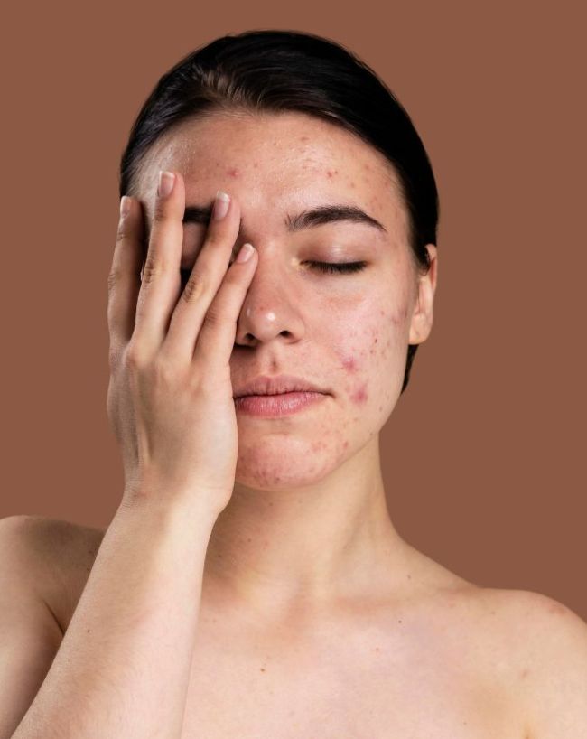 face pack for pimples-1-2-3-4-5-6